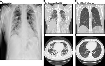 A case series report on successful management of patients with COVID-19-associated lymphopenia and potential application of PG2